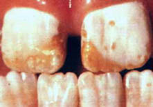 fluorosis